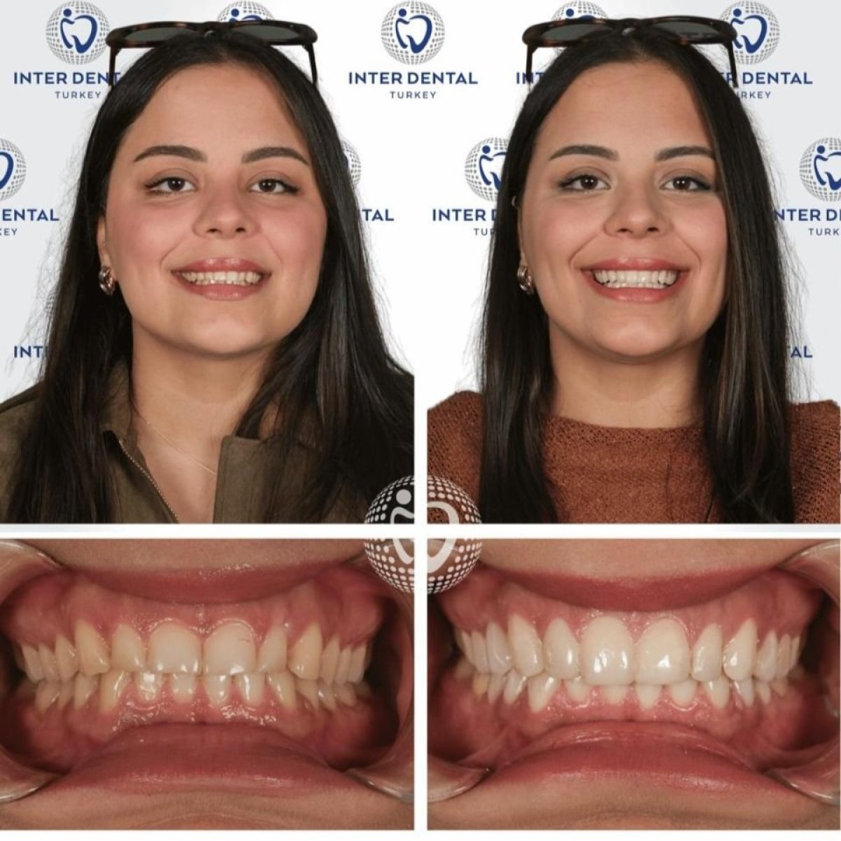 Результат до и после установки виниров Emax в Inter Dental Turkey – улучшенная улыбка