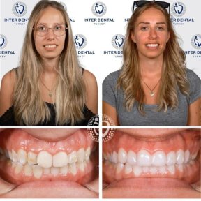 20 E-max veneers + 5*Ultra all inclusive hotel accommodation+vip transfer - photo 4