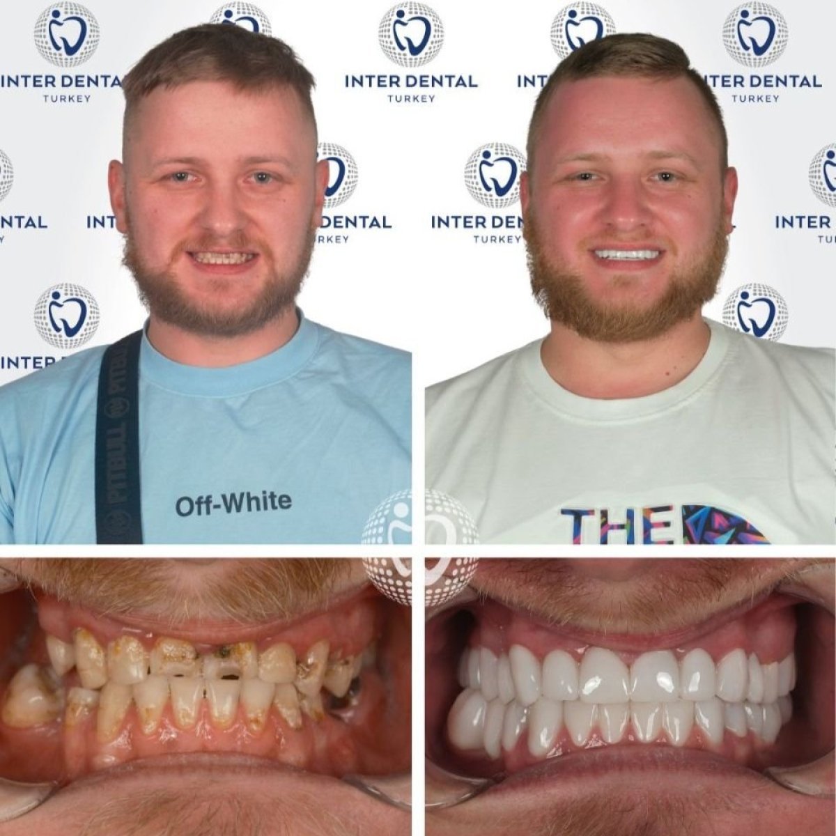 Avant/après couronnes dentaires chez Inter Dental Turkey – sourire et dents restaurés