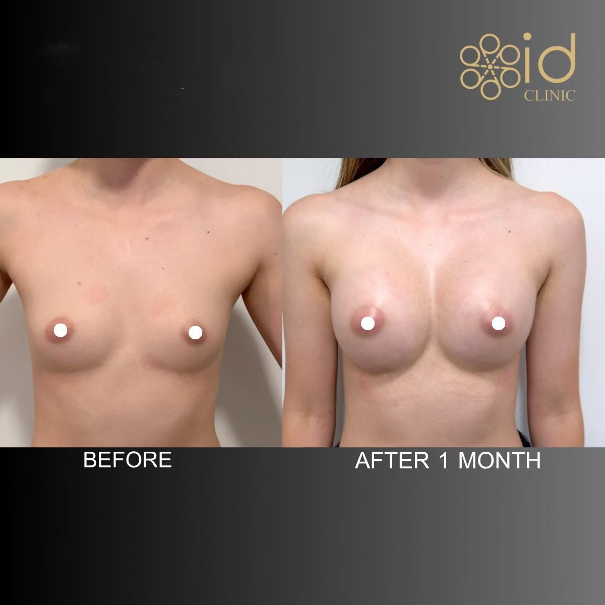 نتائج تكبير الثدي قبل وبعد في ID Clinic Bangkok، تحسن ملحوظ بعد شهر واحد