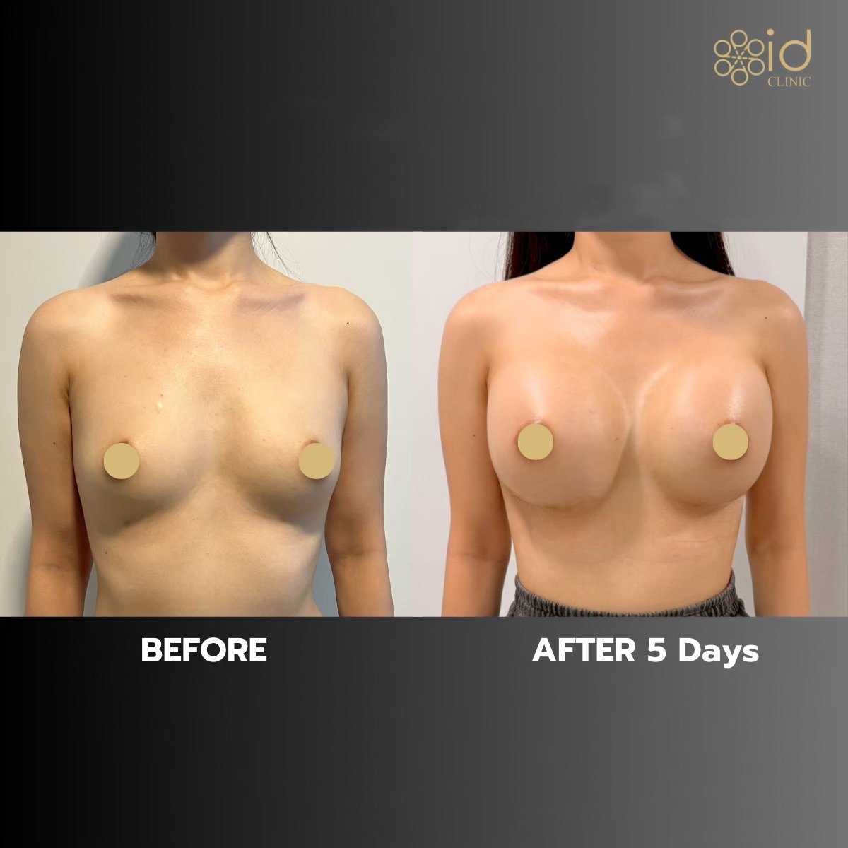 نتائج تكبير الثدي قبل وبعد في ID Clinic Bangkok، زيادة ملحوظة بالحجم خلال 5 أيام