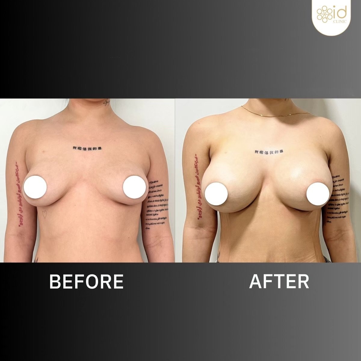 نتائج قبل وبعد تكبير الثدي في ID Clinic Bangkok، تحسين شكل الثدي