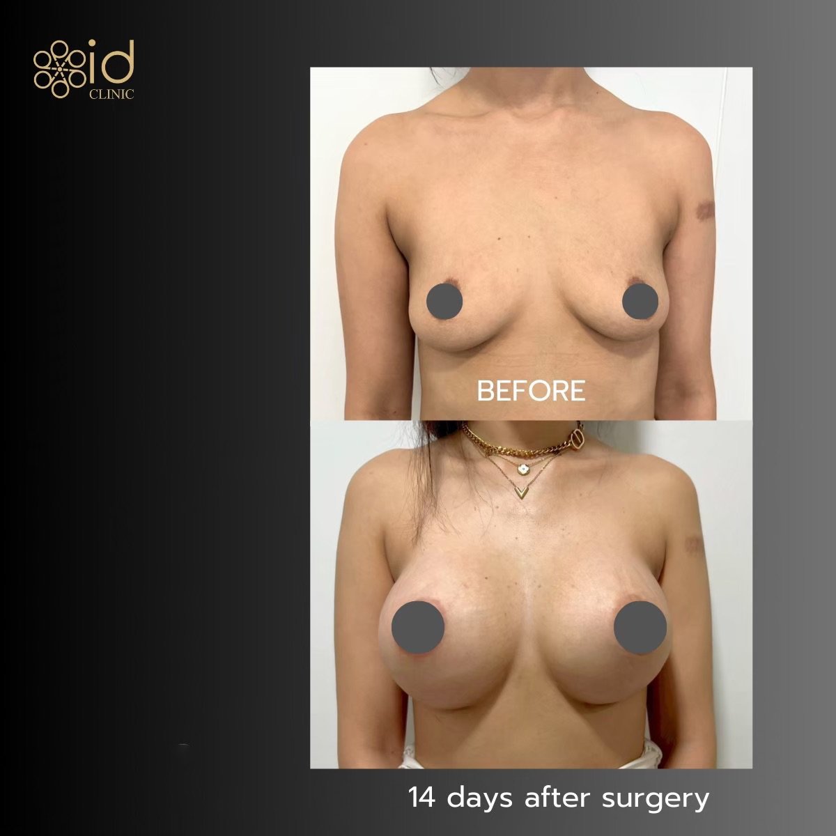 Résultats avant et après augmentation mammaire à ID Clinic Bangkok, 14 jours après chirurgie