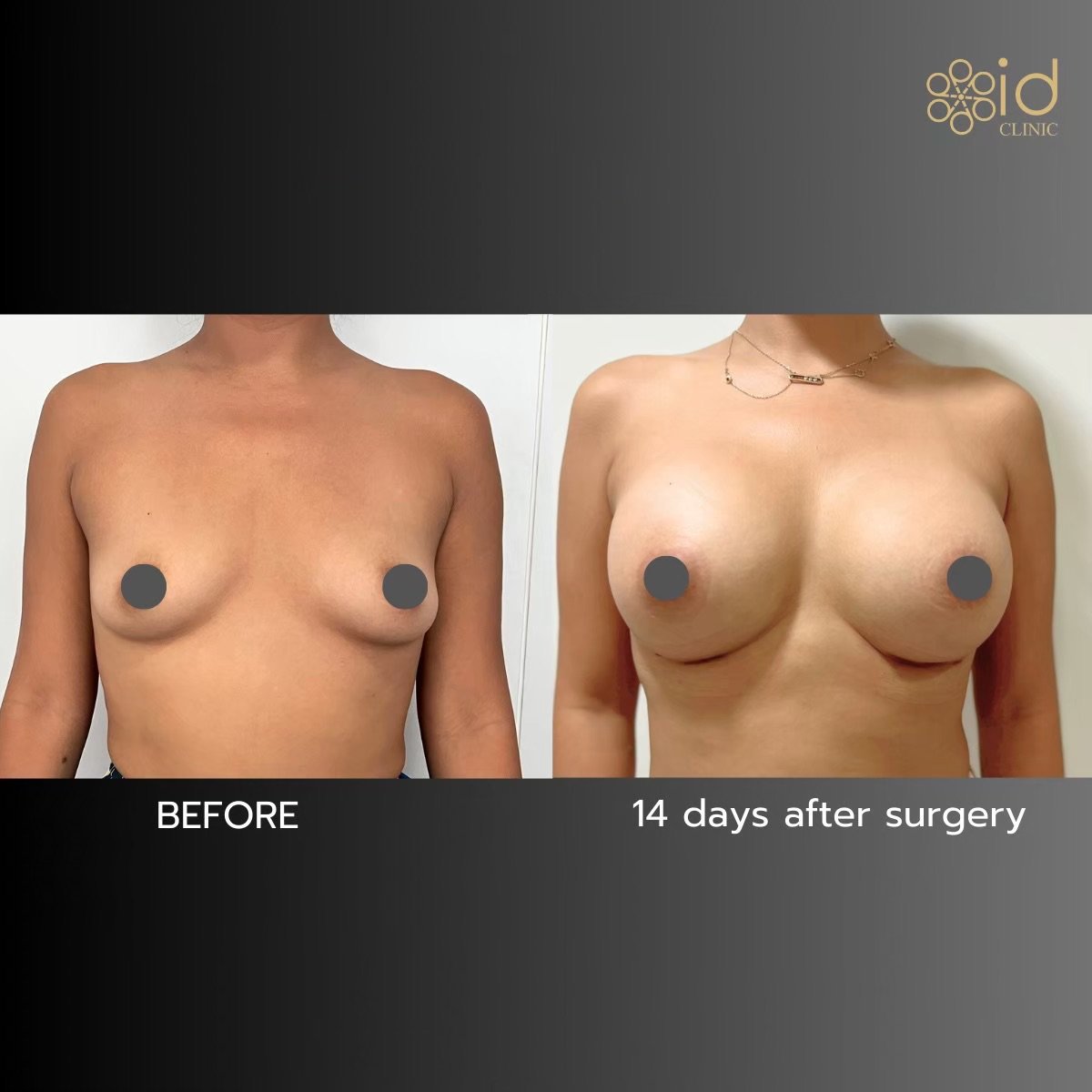 Antes y después de mastopexia con implantes redondos en ID Clinic Bangkok, resultado visible