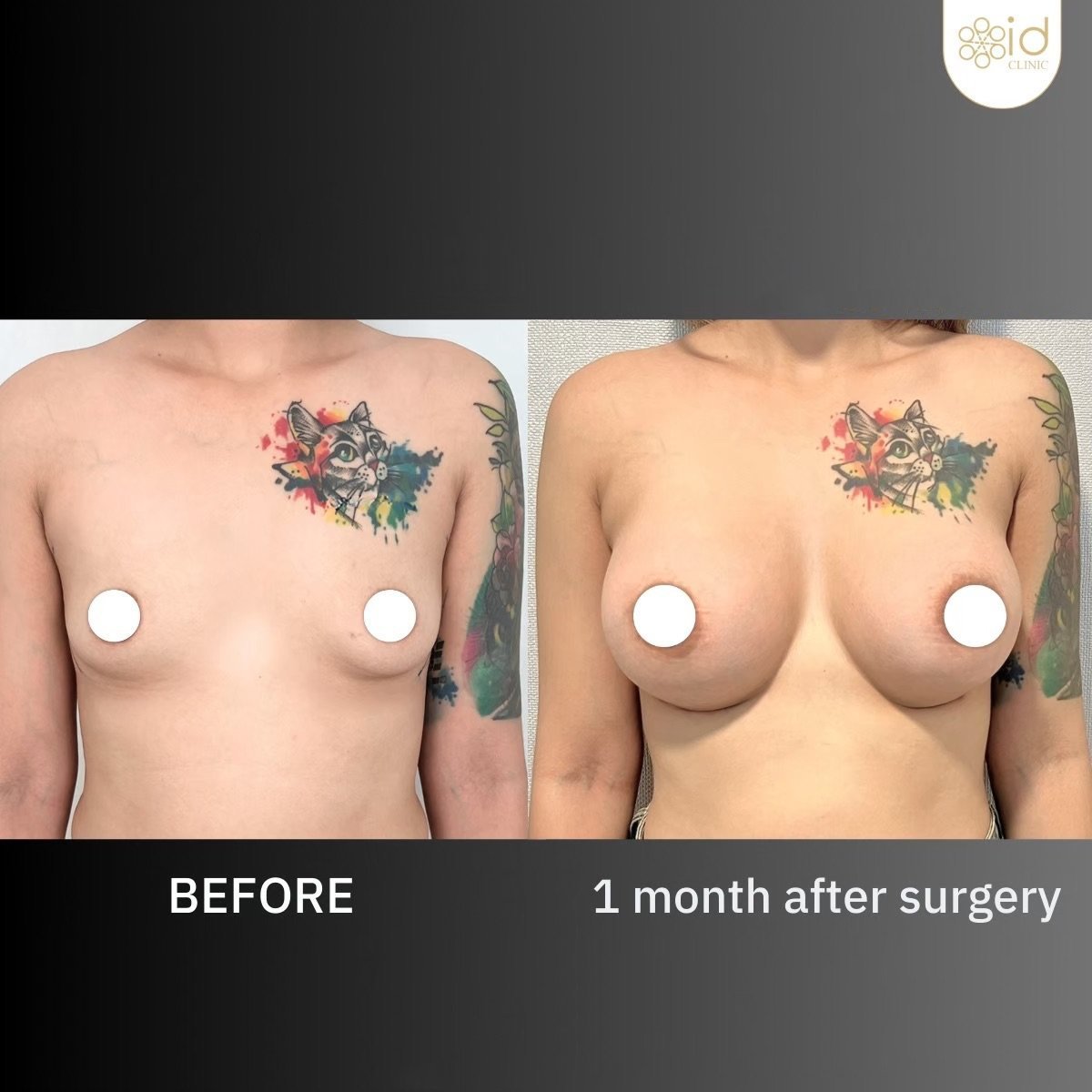 Antes y después de mastopexia con implantes redondos en ID Clinic Bangkok, resultado a 1 mes