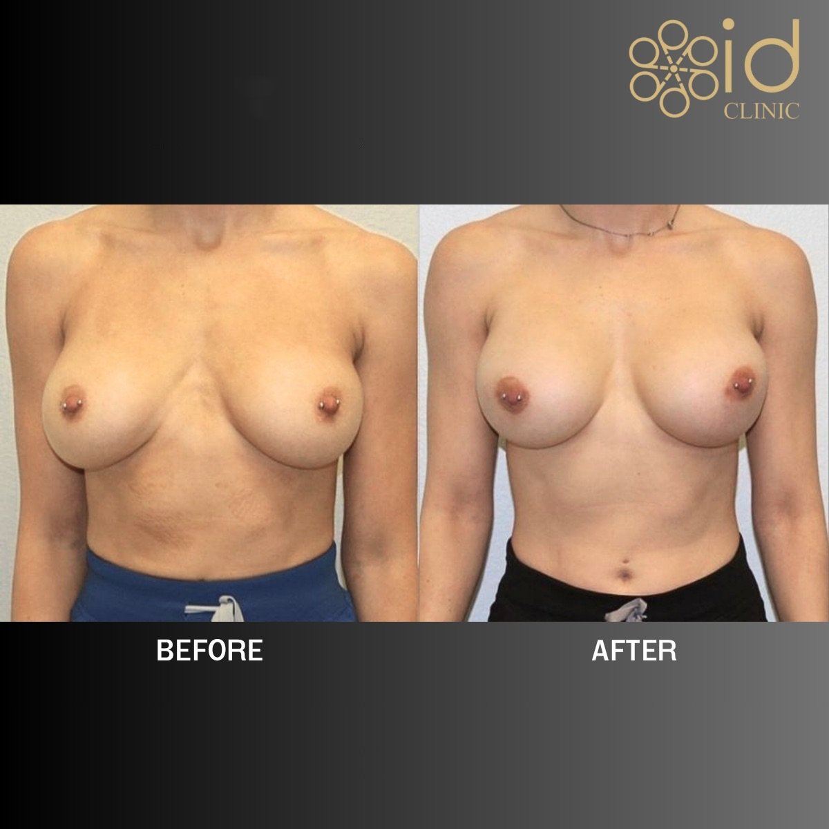 نتائج شد الثدي مع حشوات دائرية في ID Clinic Bangkok، تحسين شكل الثدي
