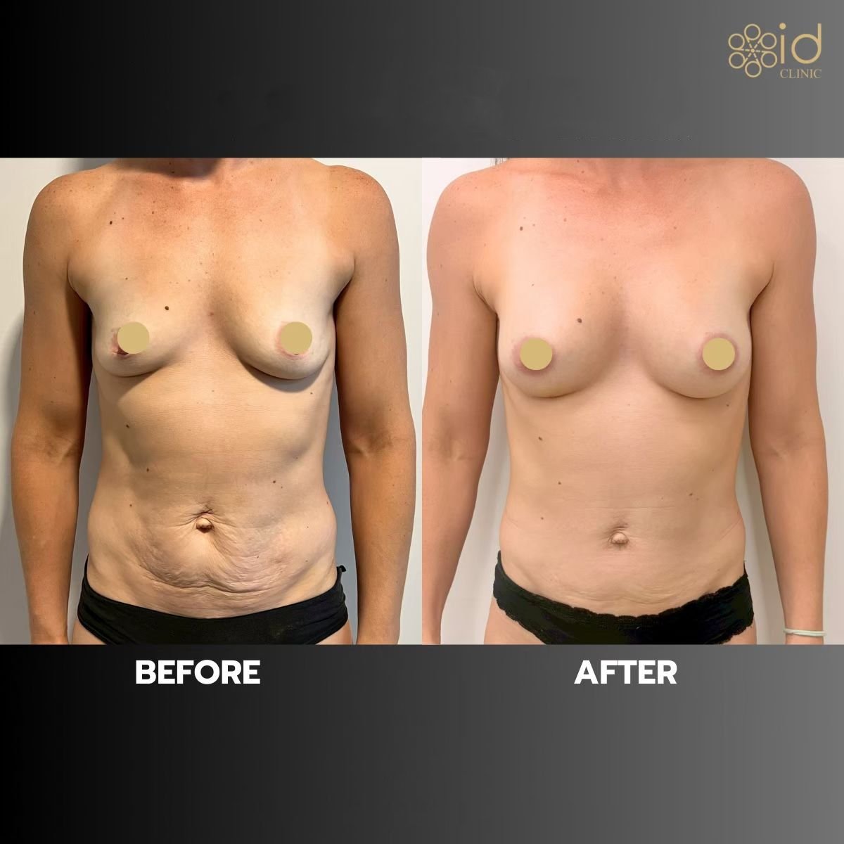 Before and after breast augmentation with fat transfer results at ID Clinic Bangkok