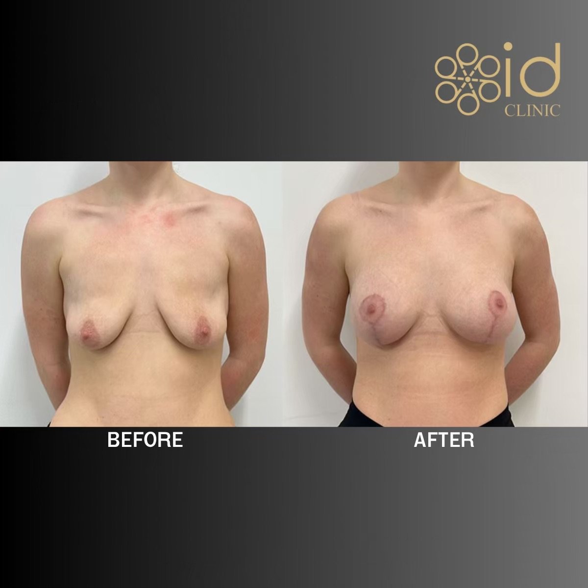 Resultados antes y después de aumento de senos en ID Clinic Bangkok, forma mejorada
