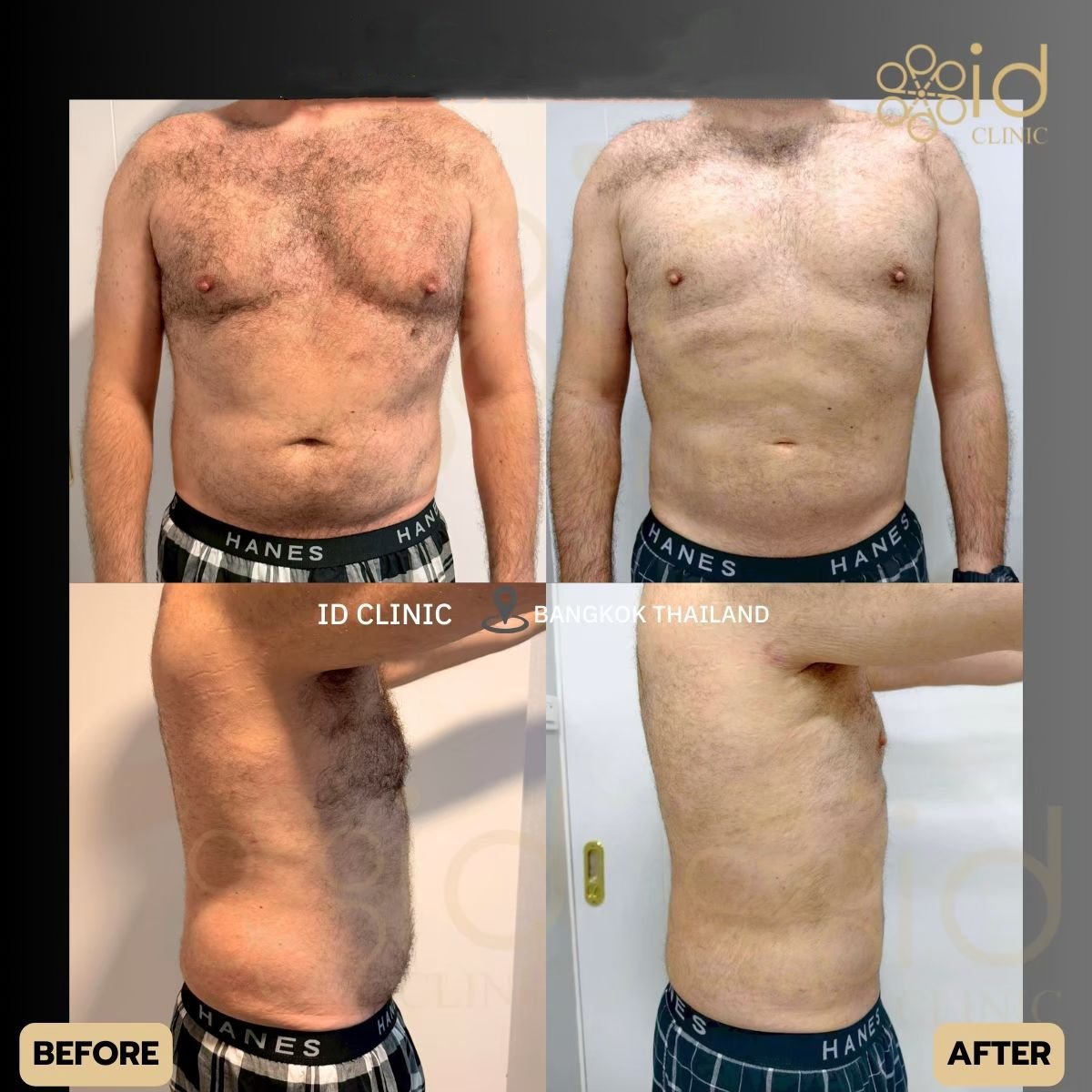 نتائج شفط الدهون قبل وبعد في ID Clinic Bangkok مع تحسين شكل جسم الرجل