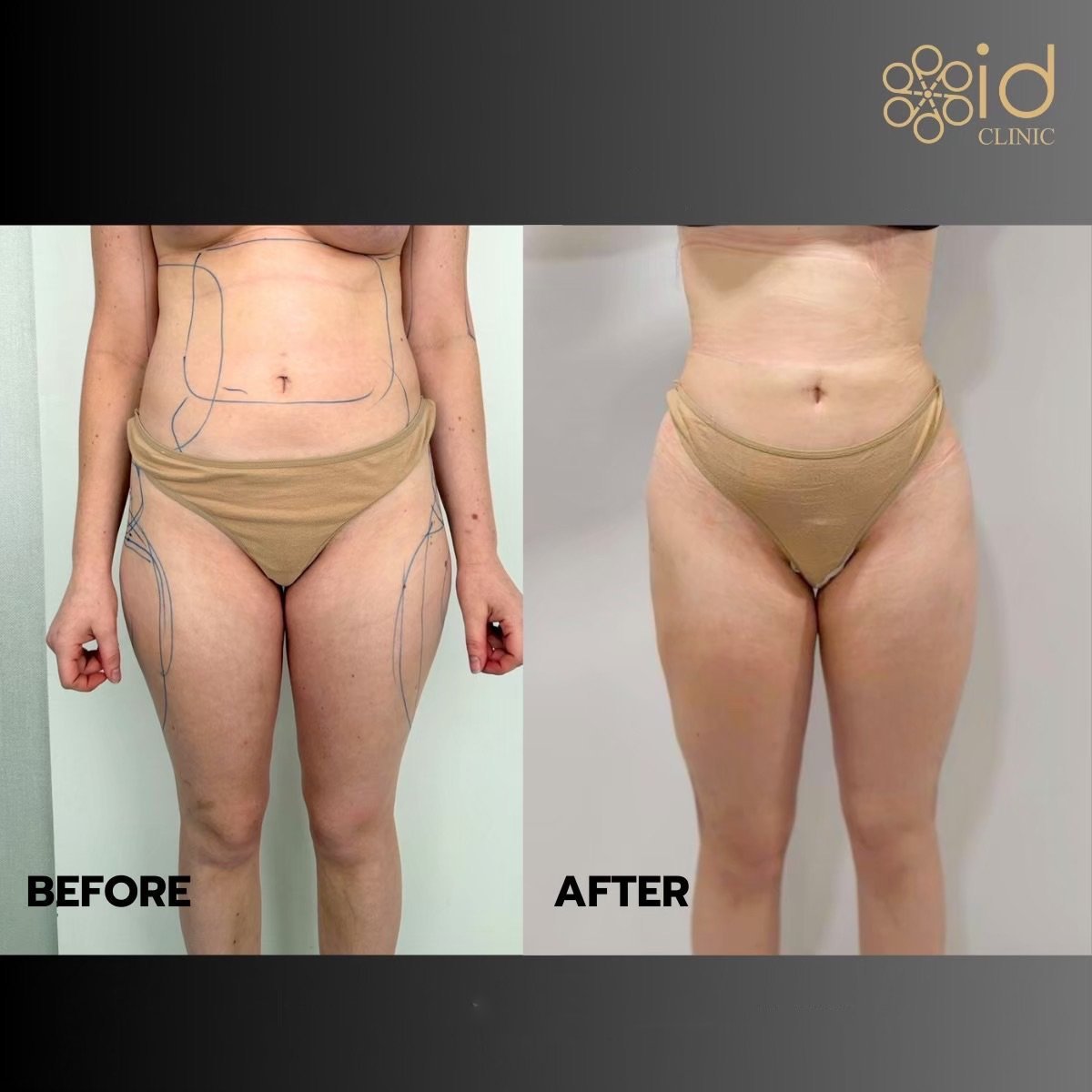 Résultats avant et après liposuccion abdominale à ID Clinic Bangkok, taille affinée