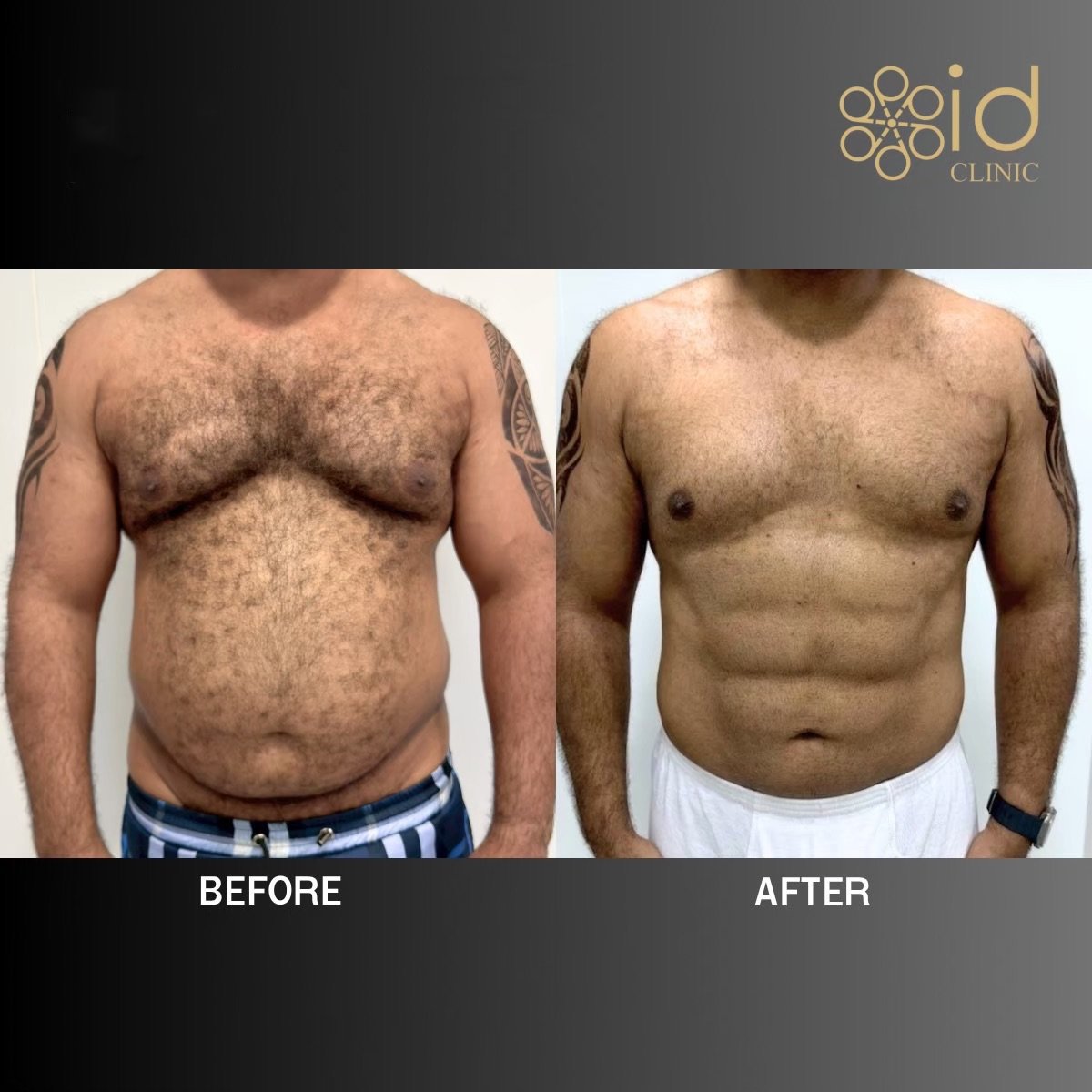 نتائج نحت البطن قبل وبعد في ID Clinic Bangkok، عضلات بطن بارزة