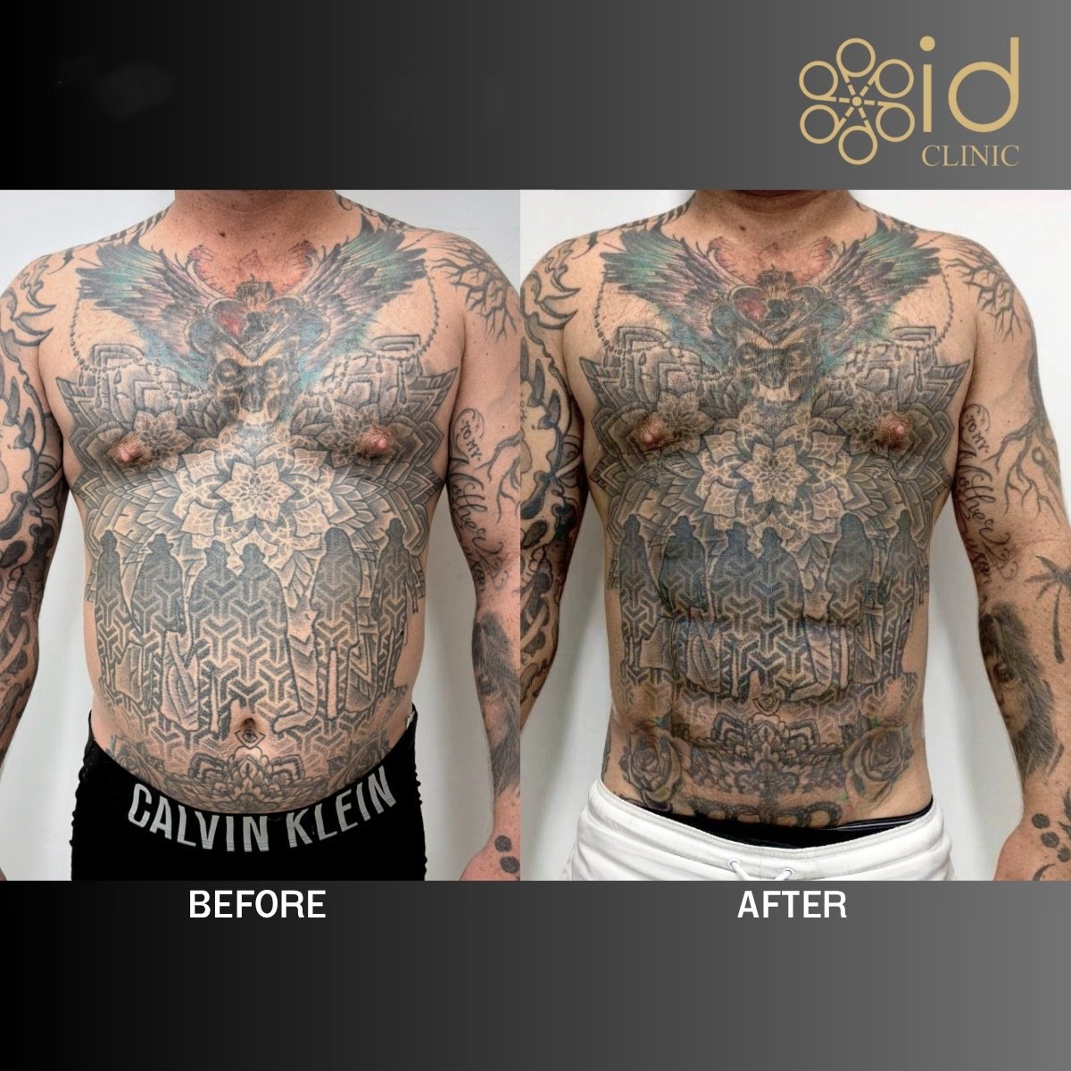 Before and after abdominal etching results at ID Clinic Bangkok, defined six pack abs