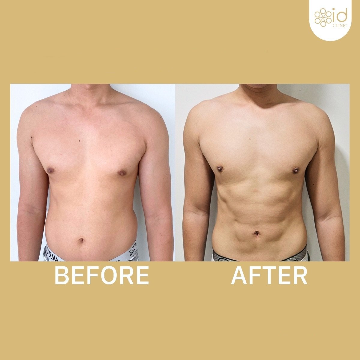 نتائج نحت البطن قبل وبعد في ID Clinic Bangkok، عضلات بطن محددة