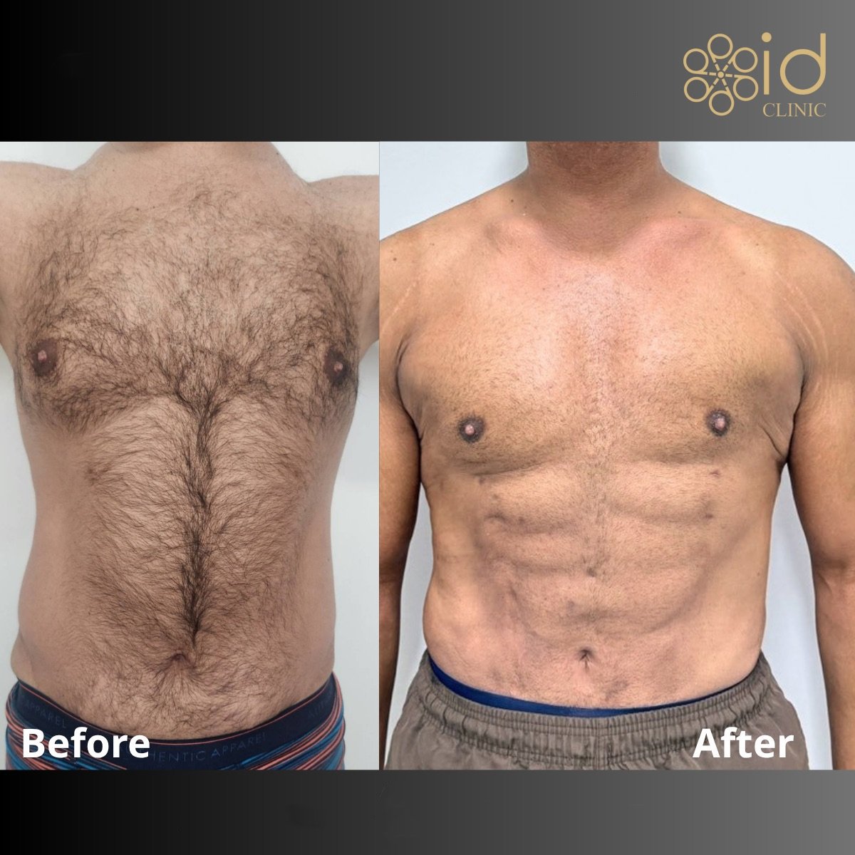 Before and after abdominal etching results at ID Clinic Bangkok, defined six pack abs