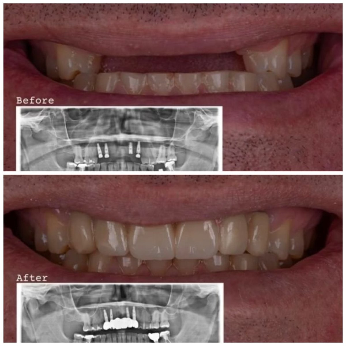 Resultados antes y después de implantes All-on-4 en DENTAL CLINIC SHTERN, sonrisa restaurada