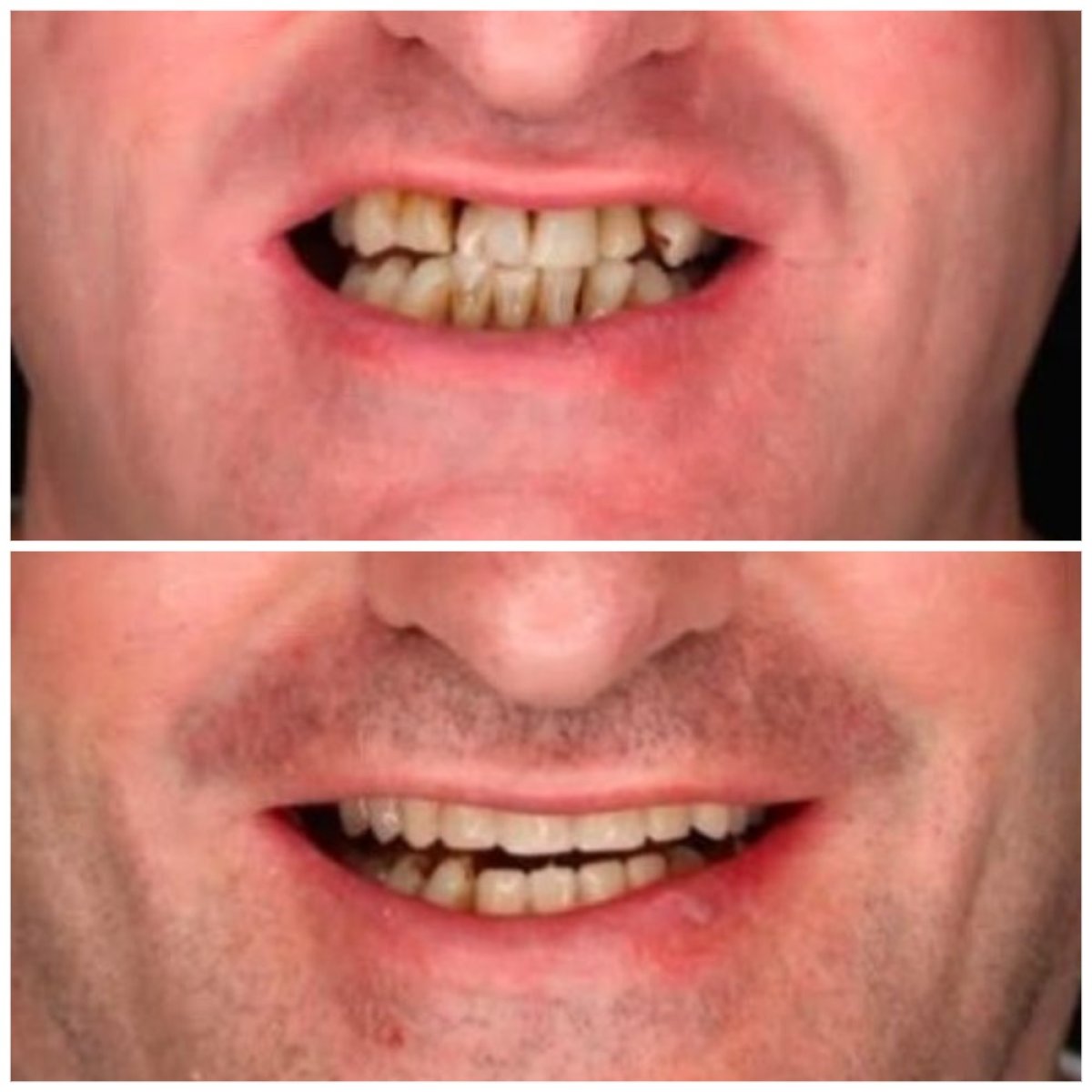 Résultat avant/après implants All-on-4 à DENTAL CLINIC SHTERN, sourire amélioré