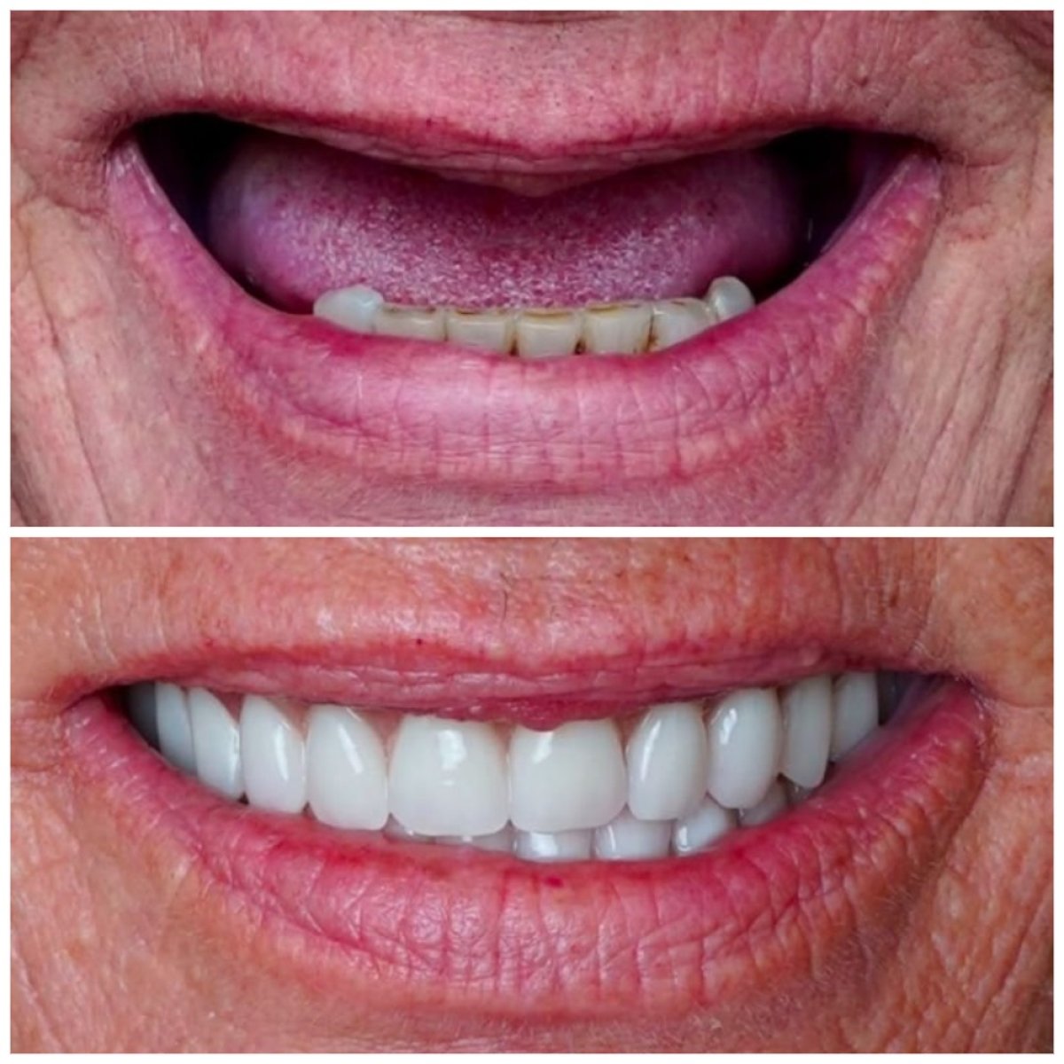 Resultado antes y después de implantes All-on-4 en DENTAL CLINIC SHTERN, restauración de sonrisa
