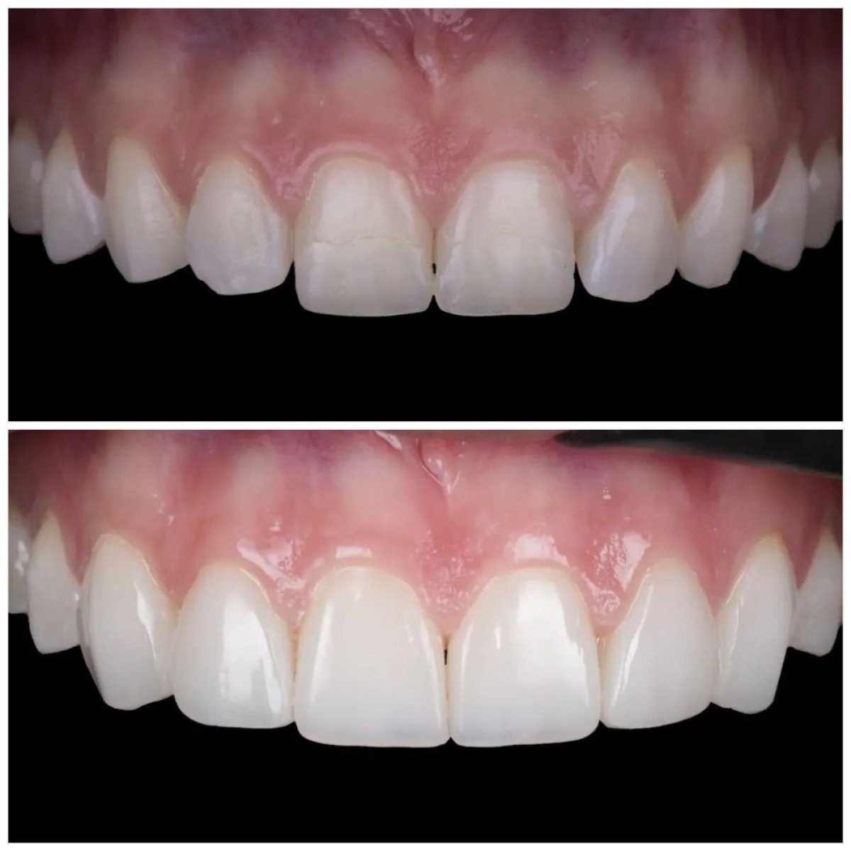 نتيجة قبل وبعد قشور الأسنان بدون تحضير في DENTAL CLINIC SHTERN، تحول الابتسامة