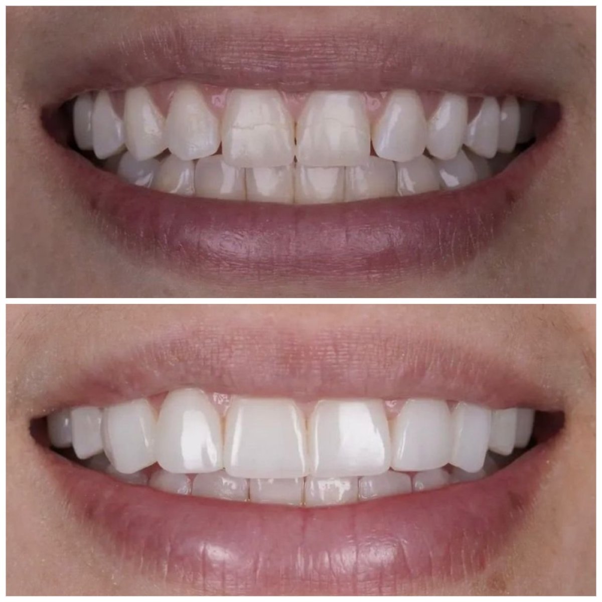 نتائج قبل وبعد قشور الأسنان بدون تحضير في DENTAL CLINIC SHTERN، تحول الابتسامة