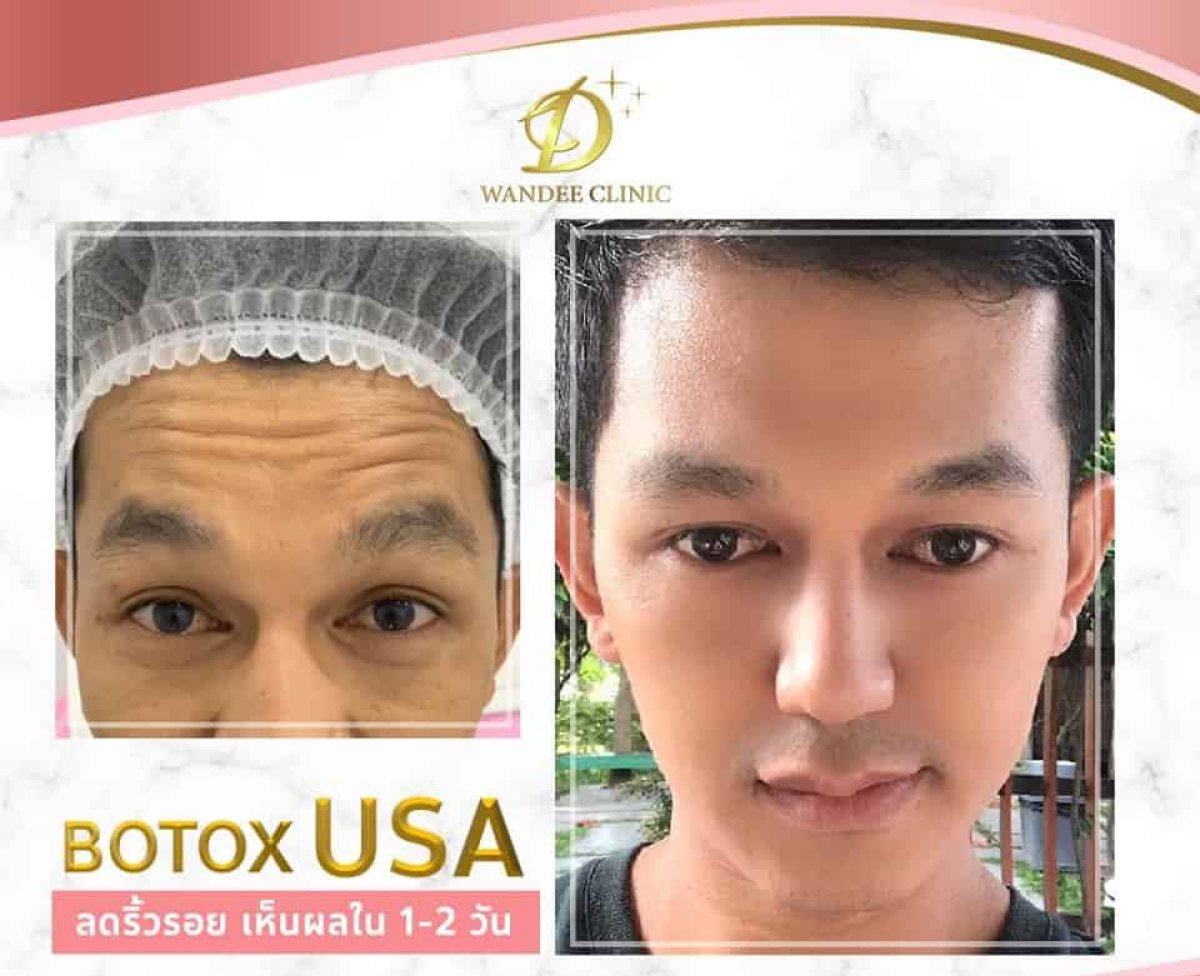 Before and after Botox wrinkle treatment results at Wandee Clinic, smoother forehead lines