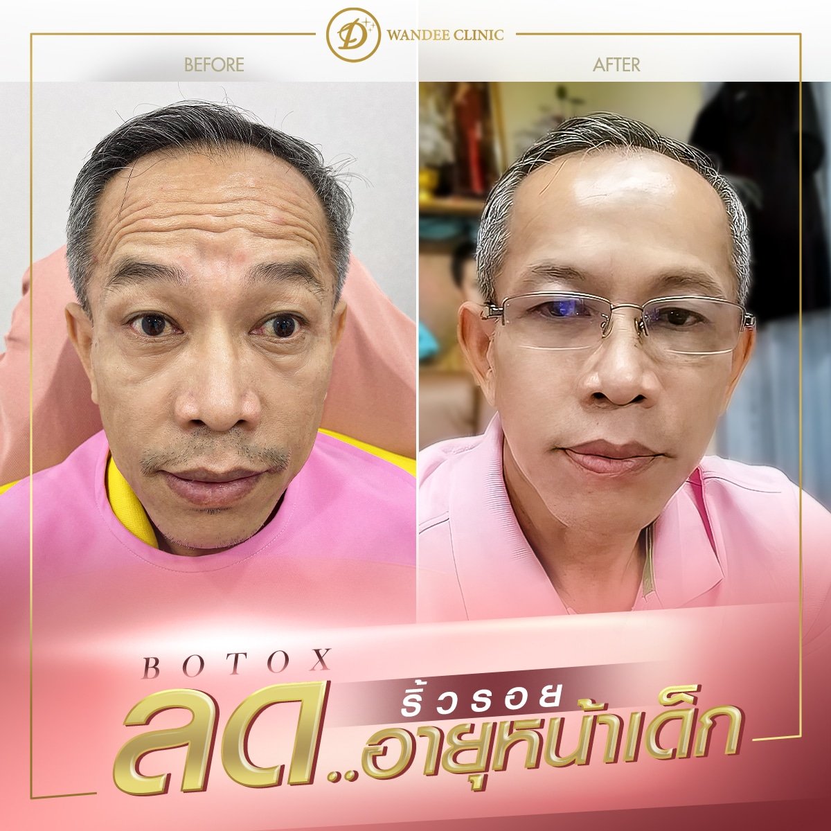 Before and after Botox for wrinkles at Wandee Clinic, visible smoother forehead result