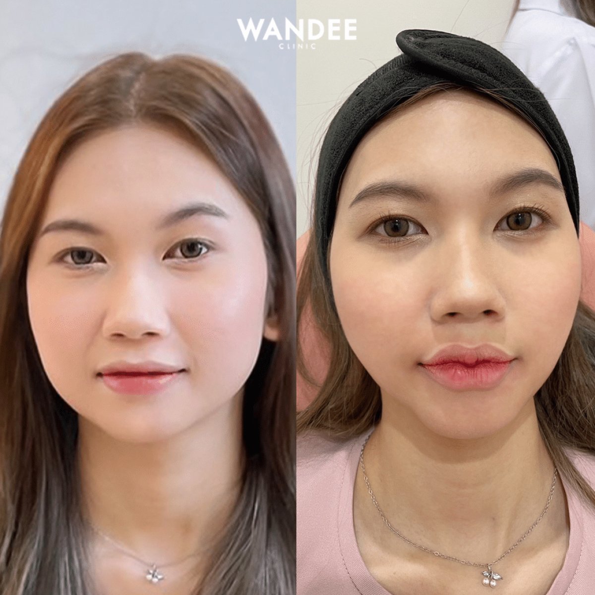 نتائج حقن الفيلر قبل وبعد في عيادة WANDEE، تحسين حجم وملامح الوجه
