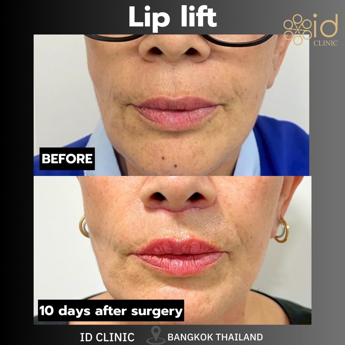 Before and after lip lift results at ID Clinic Bangkok, visible enhancement of upper lip shape