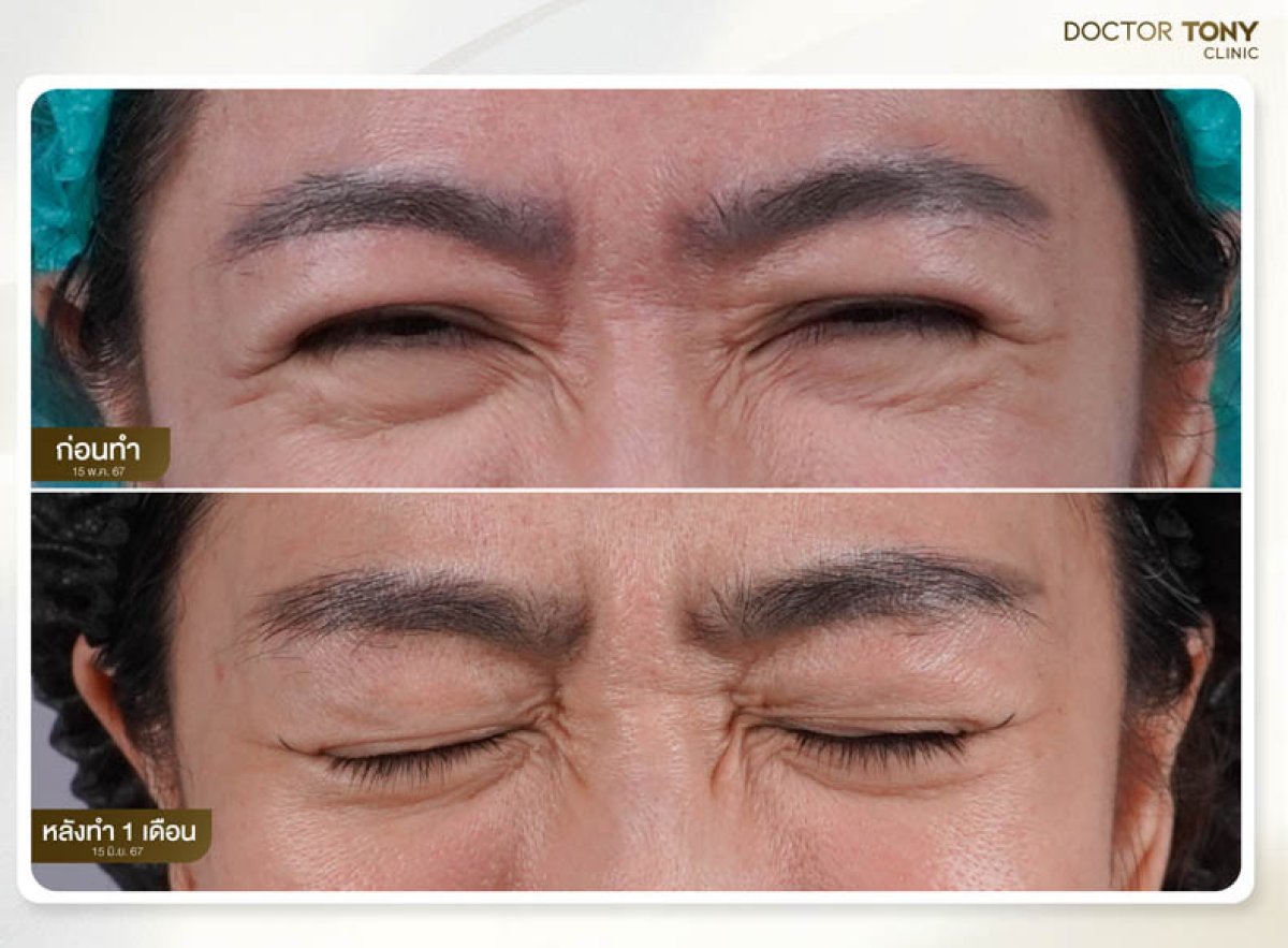 Before and after Botox for forehead wrinkles at Doctor Tony Clinic, visible smoothing result