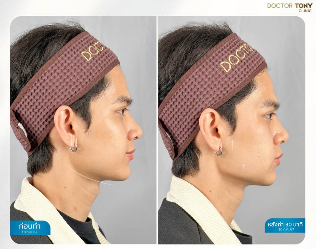 Before and after male jaw filler results at Doctor Tony Clinic – enhanced jawline contour