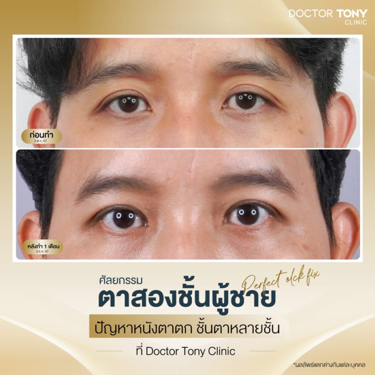 Before and after double eyelid surgery results for men at Doctor Tony Clinic