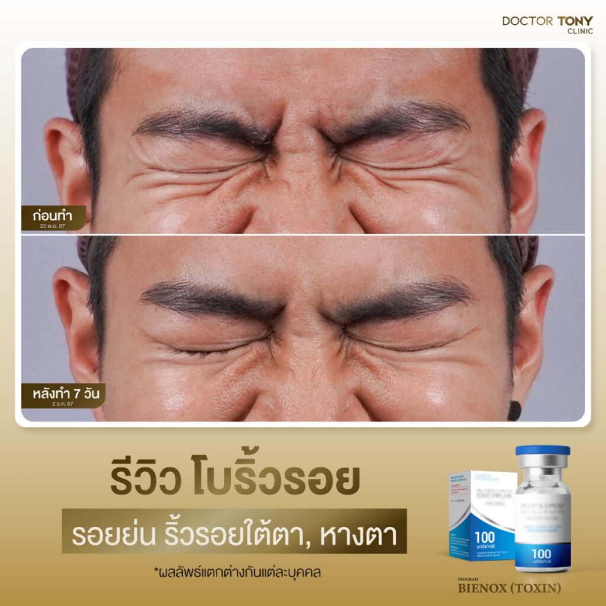 Resultados de botox para arrugas antes y después en Doctor Tony Clinic, menos arrugas oculares