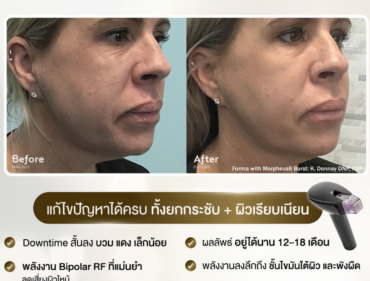 Before and after facelift results with Morpheus8 RF at clinic, visible skin tightening effect