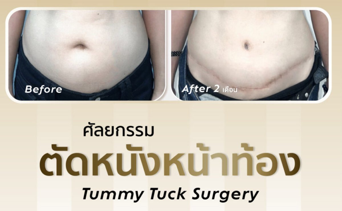 Before and after tummy tuck surgery results – flatter abdomen and visible scar improvement