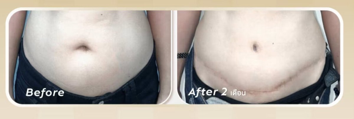 Resultados de abdominoplastia antes y después – abdomen plano y cicatriz tras 2 meses