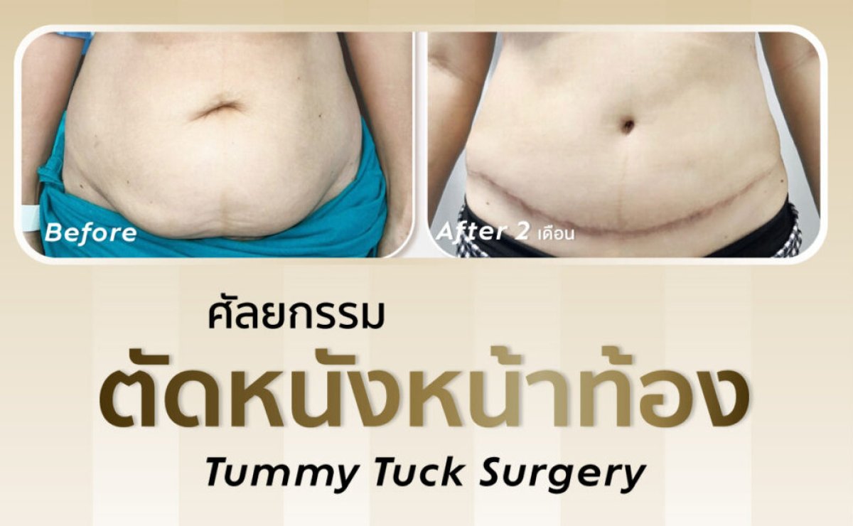 Before and after tummy tuck results – visible abdominal contour improvement after surgery