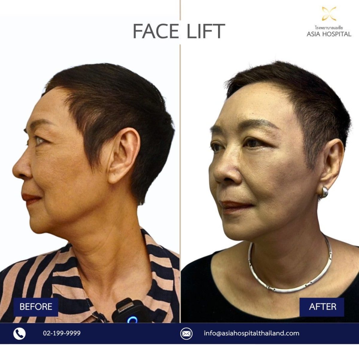 Resultados de lifting facial antes y después en Asia Cosmetic Hospital, rejuvenecimiento visible