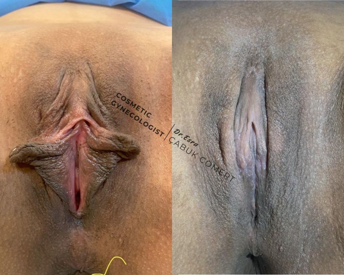 Before and after clitoroplasty results at Dr. Esra Cabuk Comert's Clinic, improved contour