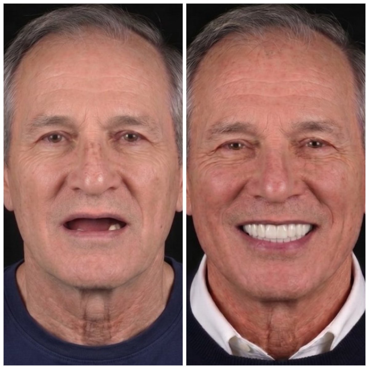 نتيجة قبل وبعد زراعة الأسنان All-on-4 في VBright Dental – استعادة الابتسامة الكاملة