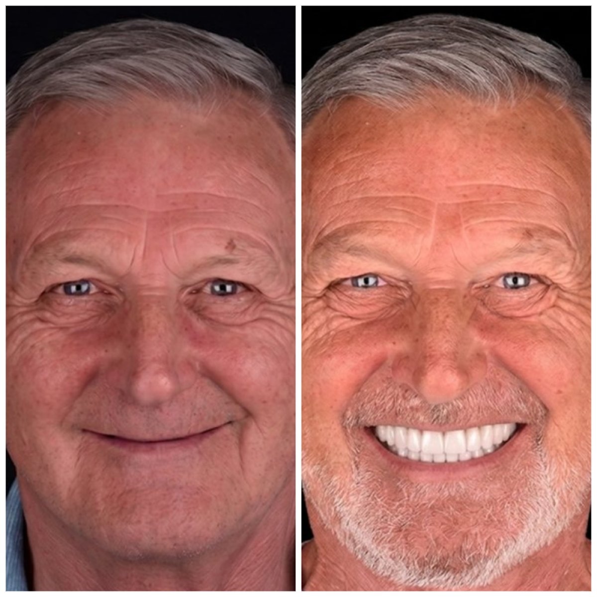 نتيجة قبل وبعد زراعة الأسنان All-on-4 في VBright Dental – استعادة الابتسامة الكاملة