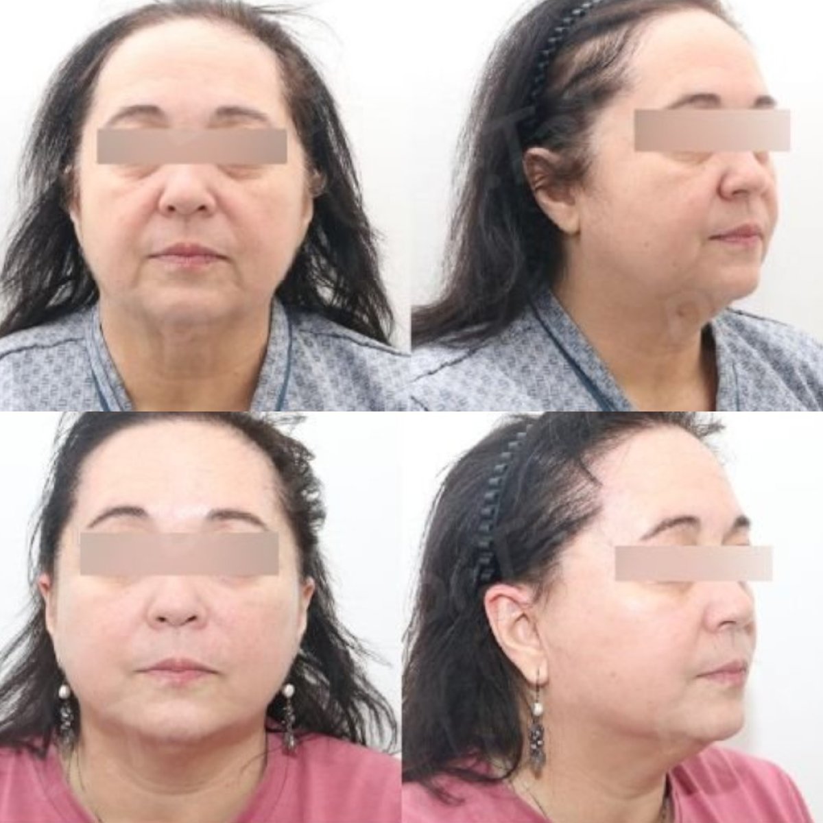 نتائج شد الوجه قبل وبعد في Dr. Tak Plastic Surgery، تجديد واضح للوجه