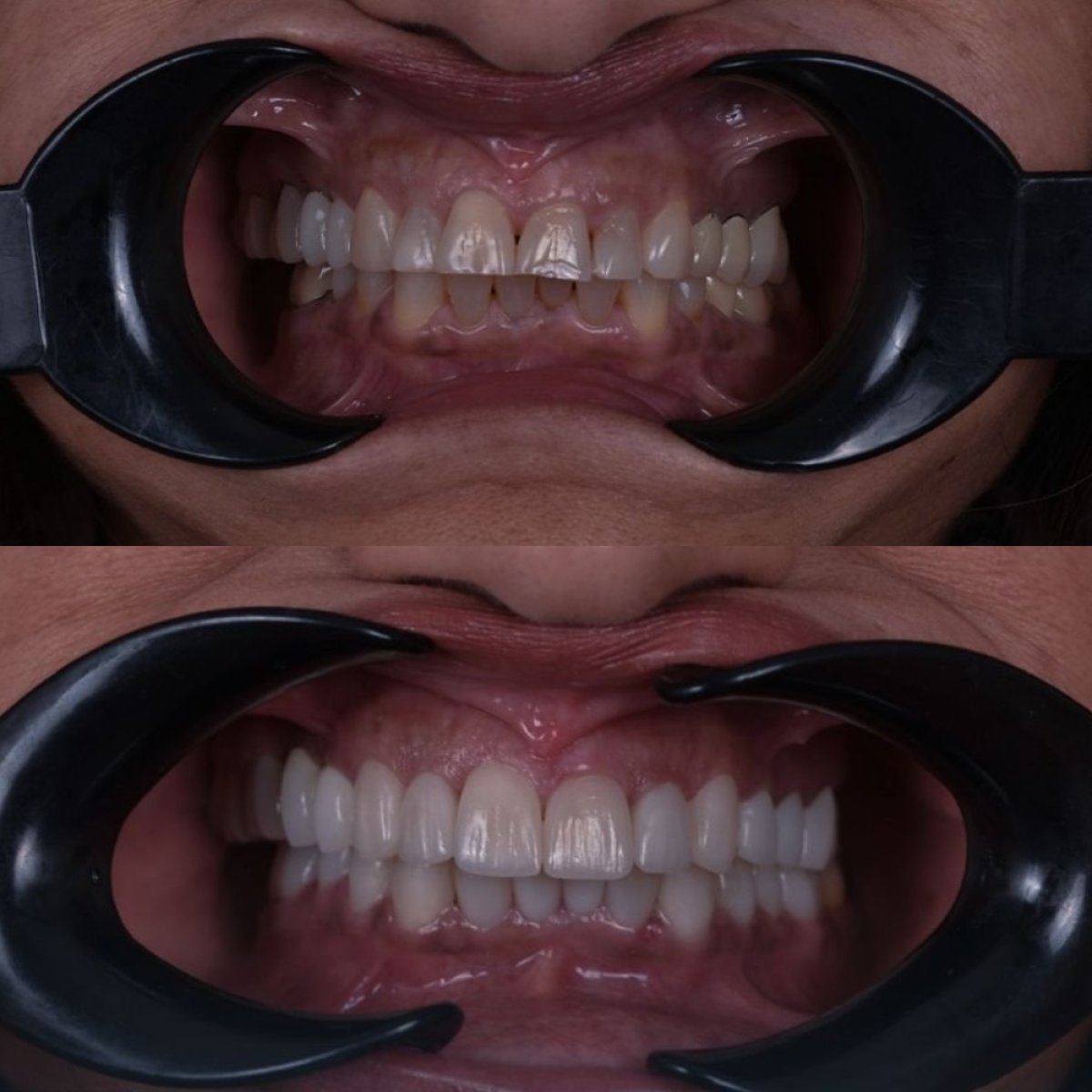 Resultados antes y después de Hollywood Smile en Dentavie Istanbul Dental Clinic, cambio de sonrisa