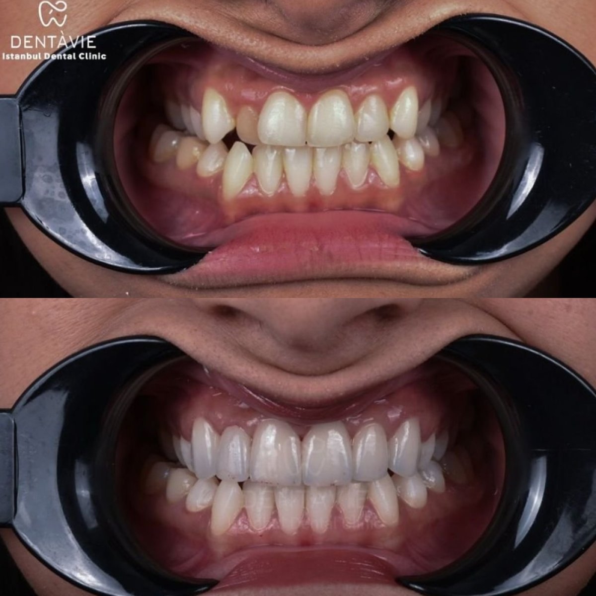 نتائج قبل وبعد ابتسامة هوليود في Dentavie Istanbul Dental Clinic، أسنان بيضاء ومتناسقة