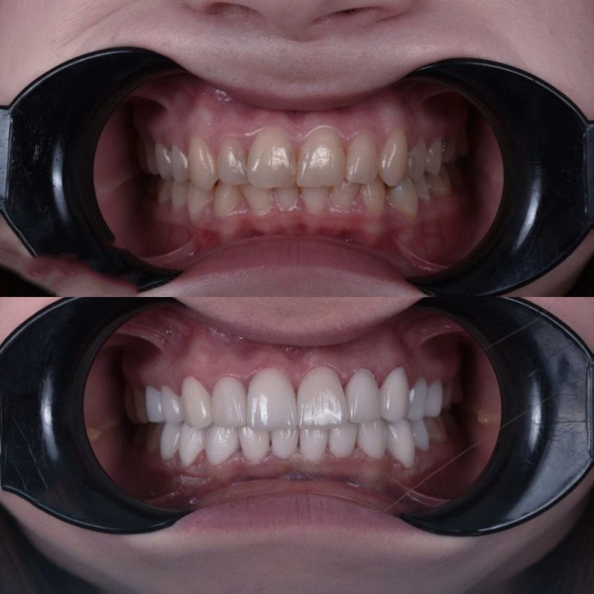 قبل وبعد ابتسامة هوليود في Dentavie Istanbul Dental Clinic، نتيجة أسنان أكثر بياضًا