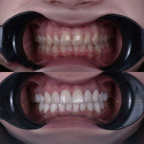 Hollywood Smile procedure with 24 zirconium crowns - photo 6