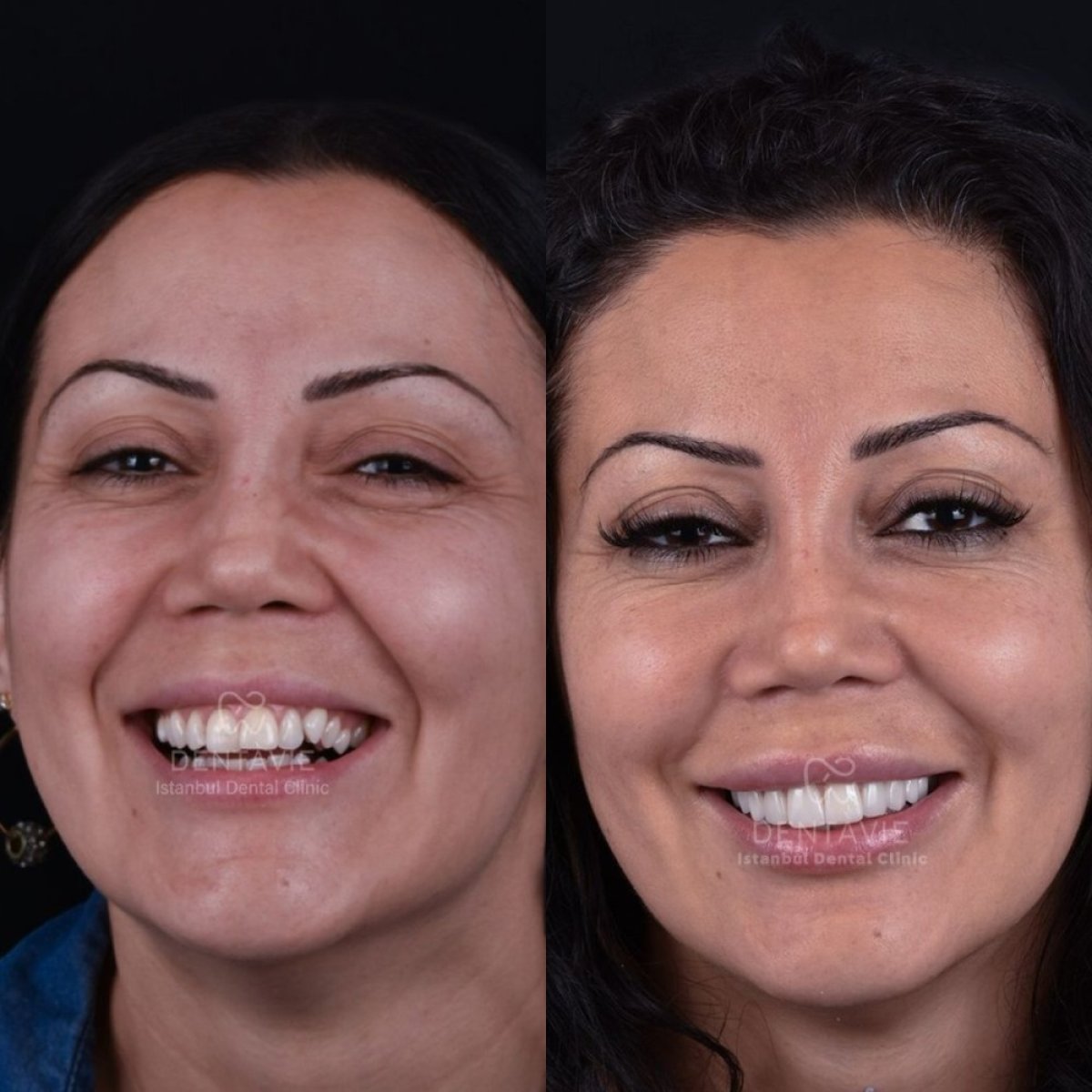نتائج قبل وبعد ابتسامة هوليود في Dentavie Istanbul Dental Clinic، تجميل الابتسامة