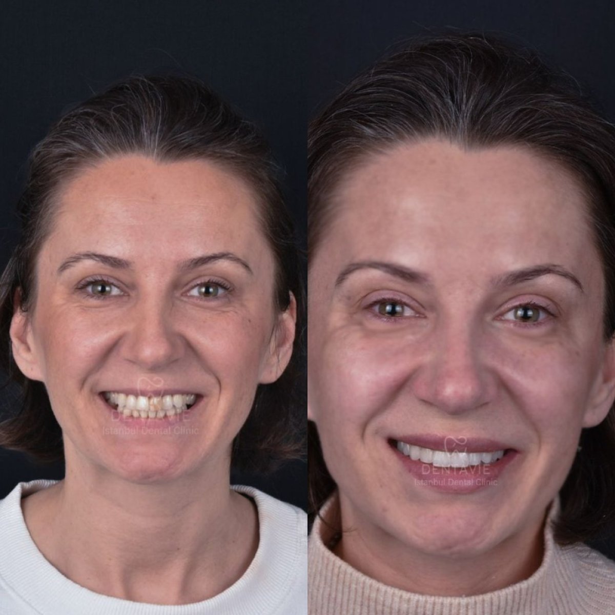نتائج قبل وبعد ابتسامة هوليود في Dentavie Istanbul Dental Clinic، تغيير الابتسامة