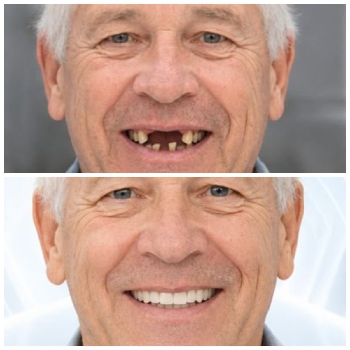 Résultats avant et après implants dentaires au Lac Viet Intech Dental Center, sourire restauré
