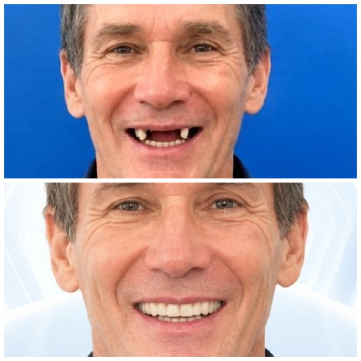 نتائج قبل وبعد زراعة الأسنان في مركز Lac Viet Intech Dental Center، ابتسامة مستعادة