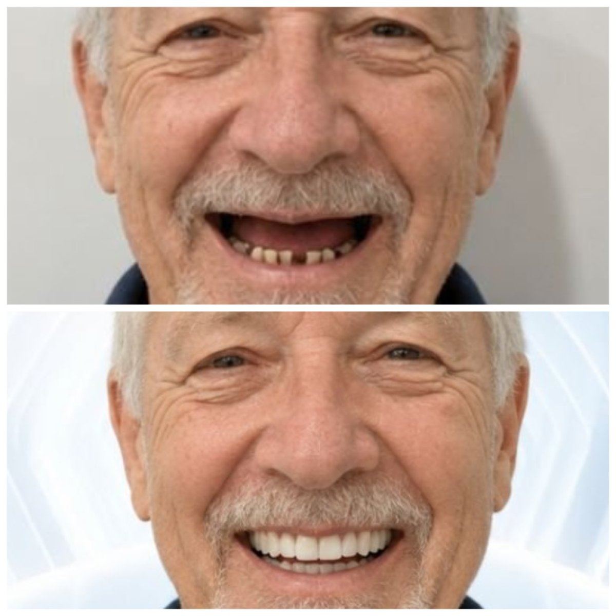 Résultats avant et après implants dentaires au Lac Viet Intech Dental Center, sourire restauré