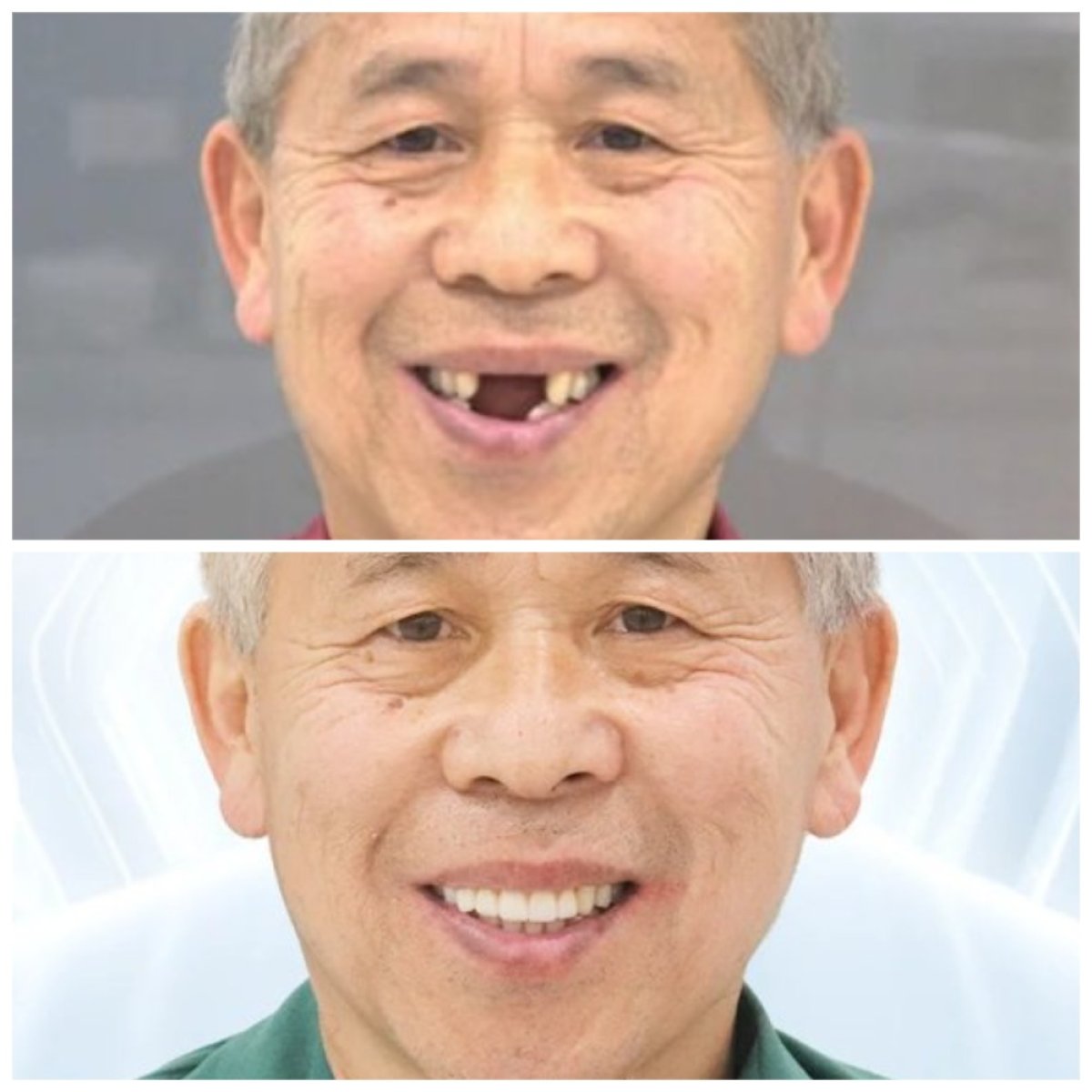 نتائج قبل وبعد زراعة الأسنان مع التاج في مركز Lac Viet Intech Dental Center، ابتسامة مستعادة
